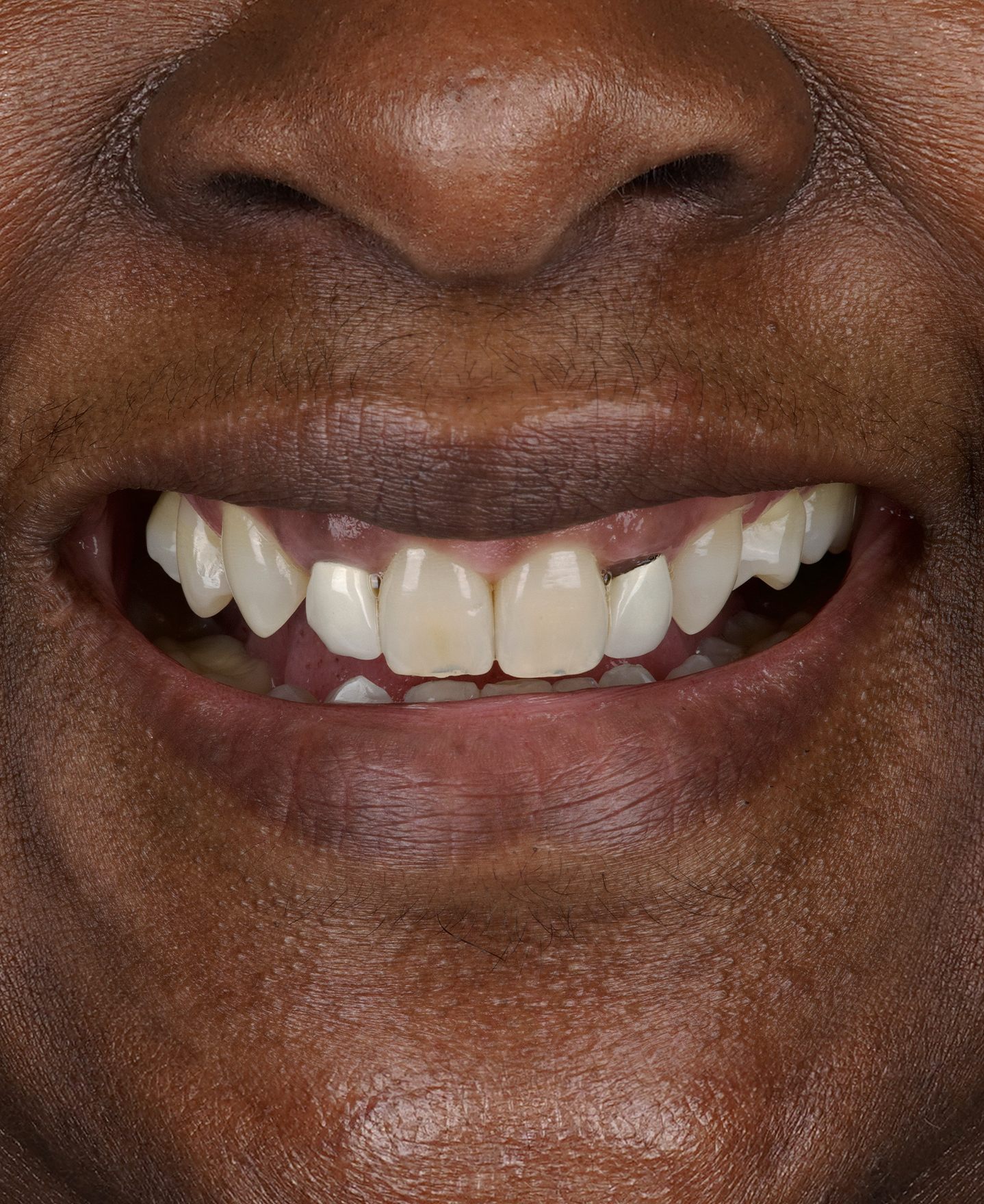 Smile Makeover — Before